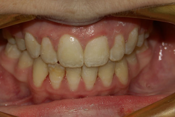 Braces After | Advanced Family Dentistry | Dentist in Cedar Park TX