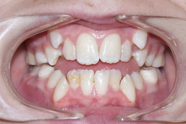 Braces Before | Advanced Family Dentistry | Dentist in Cedar Park TX