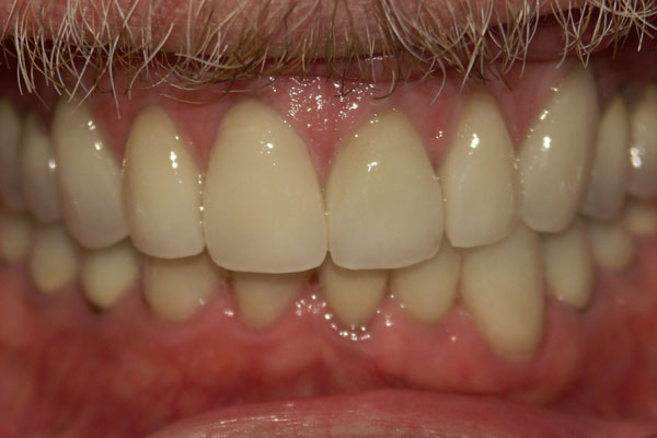 Dental Crowns After | Advanced Family Dentistry | Dentist in Cedar Park TX