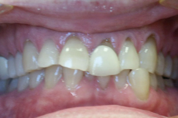 Dental Crowns Before | Advanced Family Dentistry | Dentist in Cedar Park TX