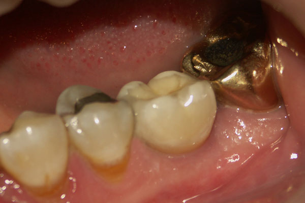 Dental Implant After | Advanced Family Dentistry | Dentist in Cedar Park TX