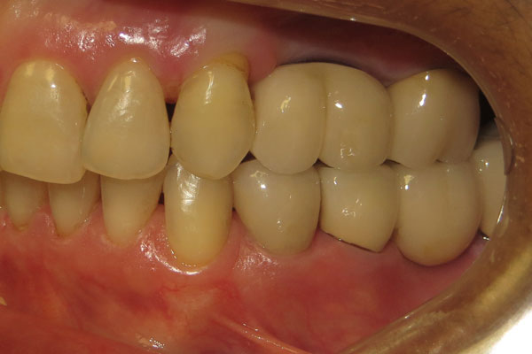 Dental Implants After | Advanced Family Dentistry | Dentist in Cedar Park TX