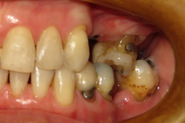 Dental Implants Before | Advanced Family Dentistry | Dentist in Cedar Park TX