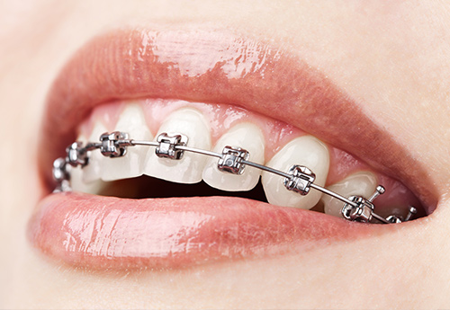 Traditional Braces | Advanced Family Dentistry | Dentist in Cedar Park TX